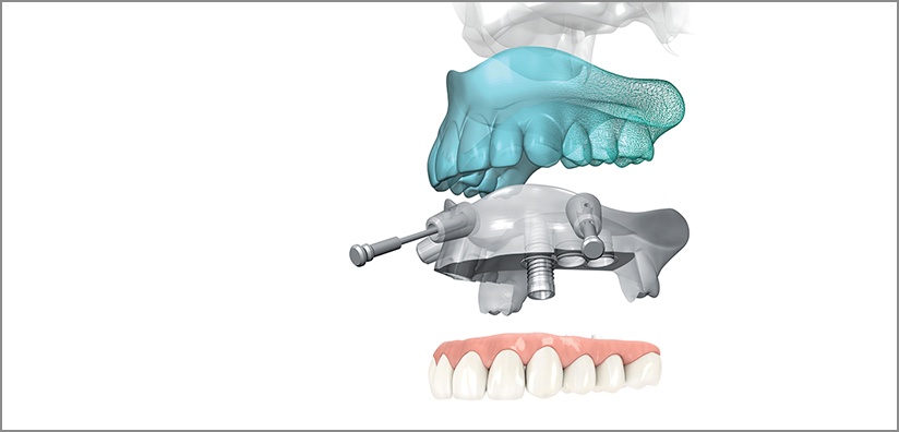 健康・医学 216 IMPLANTS Ultimate guide The Ultimate Guide To Dental Implants | Published